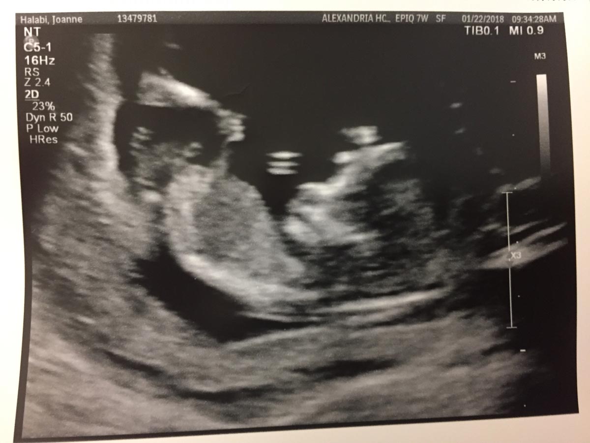 Ultrasound image of the kiddo at week 13