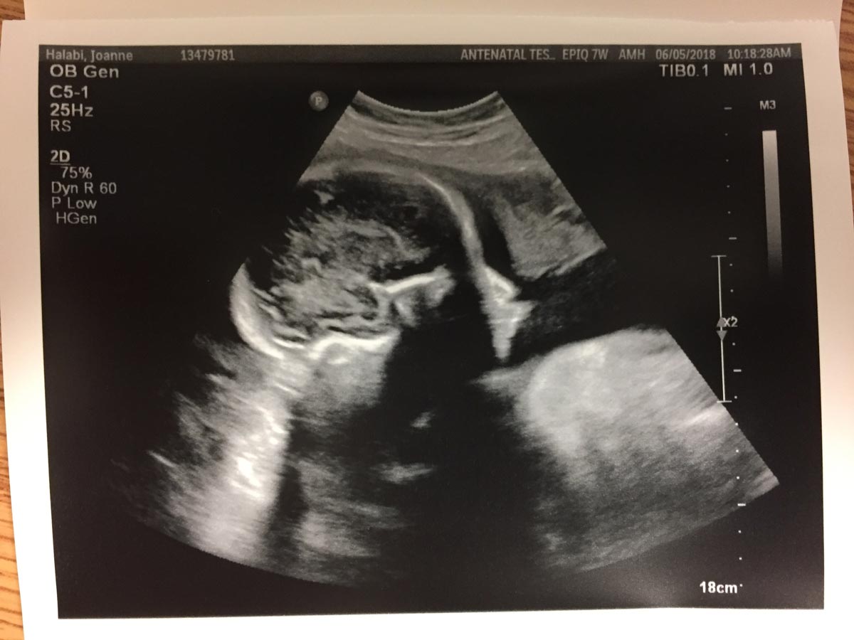 Ultrasound image of the kiddo at week 32