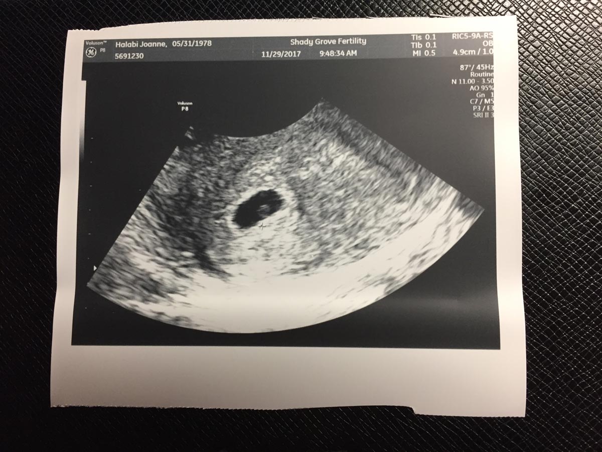 Ultrasound image of the kiddo at week 5